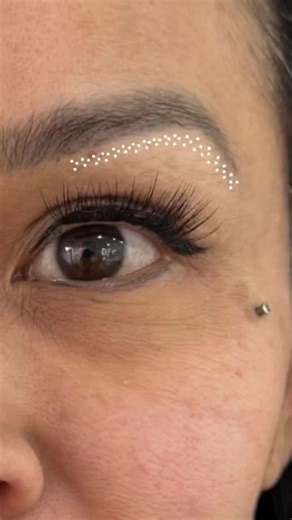 Fibroblast Eye Lifts: Transforming Monolid Eyes