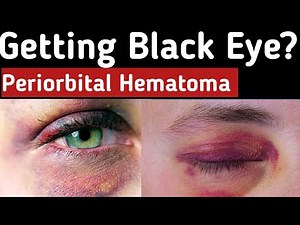 Getting a black eye- Periorbital Hematoma, What causes a black eye, Symptoms, Treatment, Preventions