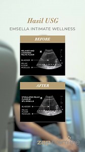 Kamu harus cek video ini untuk melihat hasil before after tindakan Emsella. Kursi yang bisa menghantarkan gelombang high intencity focused electormagnetic (HIFEM) yang mengencangkan otot panggul dalam. 📍Temukan lokasi ZAP Premiere yang tersedia Emsella: 💙 ZAP Premiere Pondok Indah (@zappremierepondokindah_) 💙 ZAP Premiere Menteng (@zappremierementeng) Percayakan perawatan area intimmu pada ahli yang terpercaya hanya di ZAP Premiere✨ #Emsella #teknologiterbaru #newteknologi #zappremiere #premi