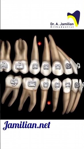 How do class 2 and class 3 elastic work #orthodontics #orthodontist #dentist #elastic #brace