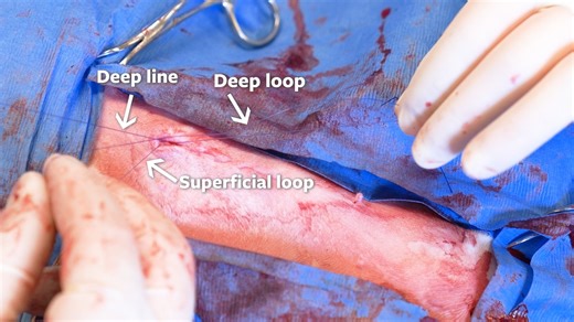 Learn how to improve apposition of the buried horizontal continuous intradermal suture pattern for skin closure in dogs and cats from a JAVMA Technical Tutorial Video: https://doi.org/10.2460/javma.25.11.0722 | Journal of the American Veterinary Medical Association - JAVMA