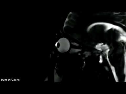 MRI Scan Of Rubbing Your Eyes