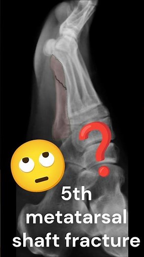 5th metatarsal shaft fracture