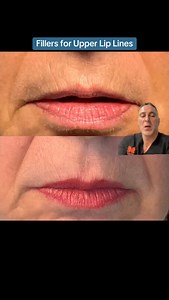 Fillers for Upper Lip Lines The best treatment for upper lip lines is CO2 laser resurfacing. But for those patients who do not have the one week of downtime for healing, we do have an option that requires no downtime. That is precise injections of a filler such as restylane silk into the lines and wrinkles. Pain Level: 1 Recovery Time: None Number of Sessions: 1 Duration of Results: Up to 1 year Procedure Name: Restylane Silk for upper lip lines #restylane #restylanesilk #fillers #upperlipwrinkl
