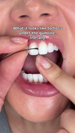 You can actually see the black floss doing its thing! Gotta get all that plaque sitting around the