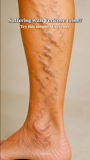 Suffering with Varicose Veins? Try These 3 Simple Exercises!