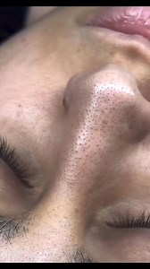 11K views · 23 reactions | Before & After hydrafacial مين هيظبط نفسه قبل العيد متنسيش تسالي علي العرض ☎️01228339370 | Janet Wedding & Engagement Dresses | Facebook