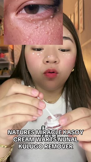 Effective Warts & Kulugo Removal with Nature's Miracle Kasoy Cream