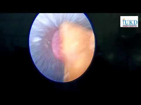 গুৱাহাটীৰ সোণাপুৰত অৱস্থিত কিডনী হস্পিটেল iUKDত PCNL পদ্ধতিৰে কিডনীৰ পাথৰৰ অস্ত্ৰোপচাৰৰ দৃশ‍্যাংশ।