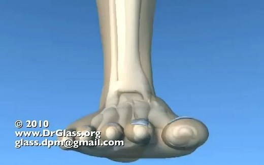 踝关节骨折 Lauge-Hansen 分型｜内旋外翻(外旋)Pronation Eversion (External Rotation)