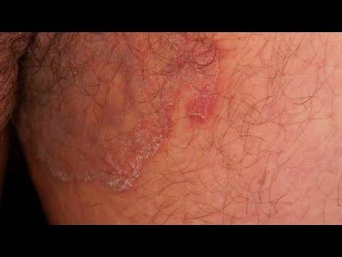 Jock Itch Home Treatment|5 ways to Cure Jock Itch Fast,Jock Itch Home Remedy