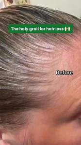 538 reactions · 22 shares | Finally put an end to your hair loss struggles with The Hair Topical Solution! This dermatologist-formulated hair growth serum treats alopecia, receding hairlines, bald spots, hair thinning, and widened parts. Transform your hair and gain confidence! Get started 100% online at Musely.com. | Musely | Facebook