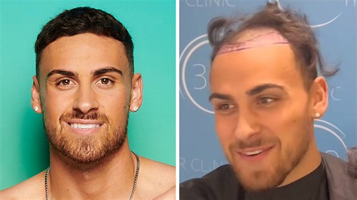 Love Island's Ben unrecognisable before £3000 hair transplant