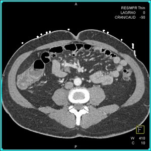 Metastatic Melanoma with Intussuception | CTisus: Cutting edge information on body CT (Computed tomography).
