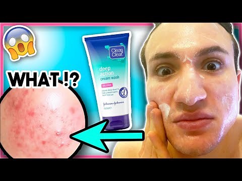 I tried Clean and Clear ACNE CREAM face wash for ONE WEEK!
