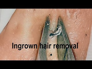#11 Ingrown hair removal