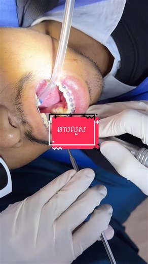 ឆាបលួស #greatsmiledentalclinic #ពត់ធ្មេញ #teamធ្មេញដែក #ព្យាបាលធ្មេញ #brace