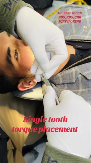 Single Tooth Torque Placement Techniques