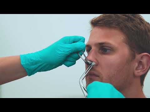 The Management of Epistaxis