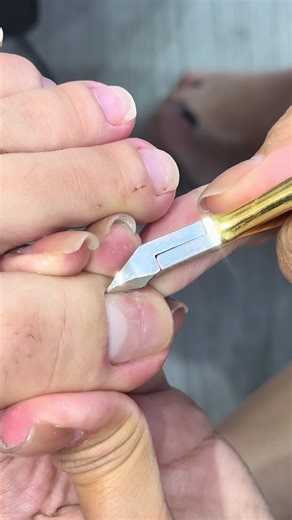 Khoé nhiều mảnh #lấy_khoé_chân #lấykhoé #khoéchân #lấykhoémóng