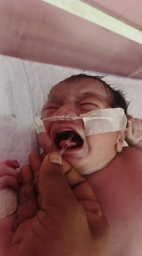 🩺 Newborn Baby NG Tube Insertion Orally | How to Insert NG Tube Step by Step | Baby Care in NICU