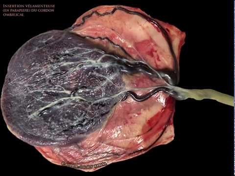 Cordon ombilical : insertion vélamenteuse - échographie et images cliniques