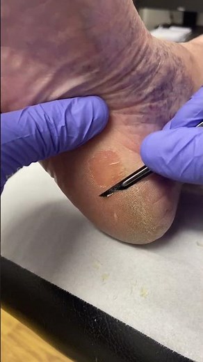 See how an expert podiatrist tackles thick heel calluses! 💪👣 #FootCare #PodiatryMagic