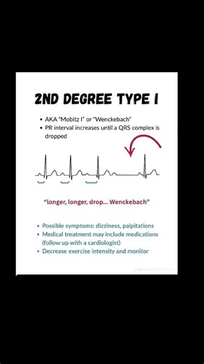 2nd Degree AV block #ecg #cardiology