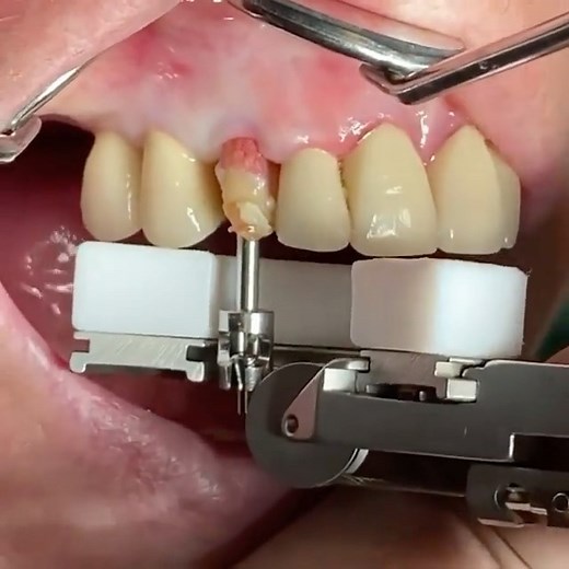 Dentistrysociety on Instagram: "Atraumatic tooth extraction done by @dr.eik.schiegnitz 👏 the beauty of Benex 🦷 - minimal invasive tooth extraction 🧨🚀. Especially indicated in immediacy protocols."