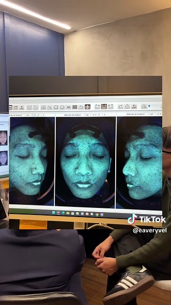 Effective Skin Testing Procedure for Acne-Prone Skin