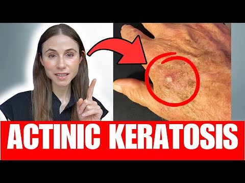 Dermatologist Explains Actinic Keratoses Early Signs and Treatment