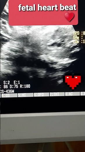 HOW FETAL HEART BEATS ❤ obs #ultrasound reveals #fetal heart beat #pregnancy