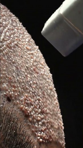 Hair Transplant procedure with grafts. Before & After | Care4Hair