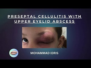 Preseptal cellulitis with upper eyelid abscess