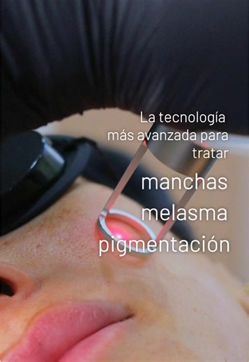 LÁSER PICOWAY✨ #tijuana #picolaser #melasma #manchasenlapiel #hiperpigmentacion
