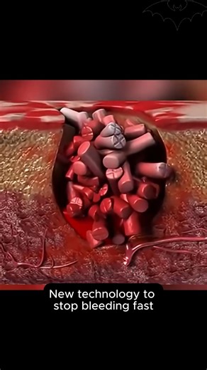 David Abbasi, MD | Orthopedic Sports Surgeon on Instagram: "This device represents a new approach to rapid bleeding control. Using a syringe-like applicator, small compressed sponge pellets are delivered into a wound, where they quickly expand upon contact with blood or fluid. The expansion creates internal pressure that helps stop bleeding fast—especially in deep or irregular wounds where traditional compression is difficult.” Use cases include: • Emergency trauma care • Severe bleeding in acci