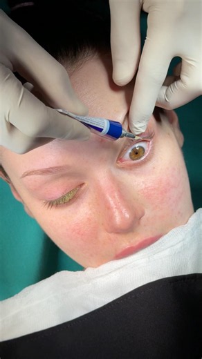 Piezo ultrasonic rhinoplasty 🔥🔥 barbienose #princessnose #rhinoplasty ##erdiozdemirnoses