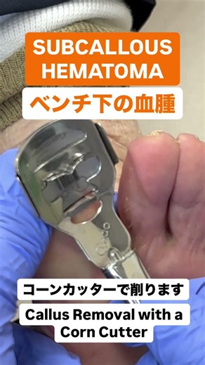 I trimmed a subungual hematoma with a corn cutter: Treatment video