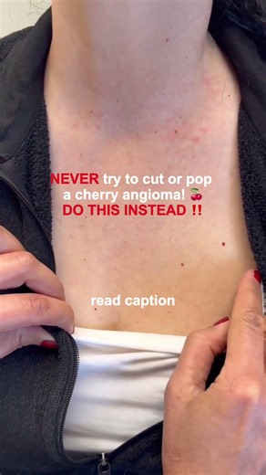 Never try to cut or pop a cherry angioma! Do this instead!