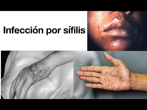 Syphilis Infection - Everything You Need to Know - Symptoms, Diagnosis and Treatment