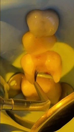 We restored this tooth with a 3D-printed inlay—no root canal, no crown, just biomimetic dentistry.