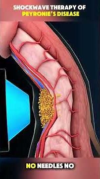 Realistic 3D View of Shockwave Therapy for Peyronie’s Disease