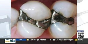 Tooth Talk with Dr. T:  amalgam fillings