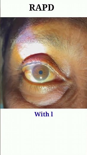 RAPD testing | Optic nerve test | Swinging flash light test #eyecareoptom #shorts #rapd #short #eye