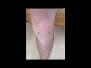 Knee Arthroscopy/keyhole Surgery for meniscus tear.