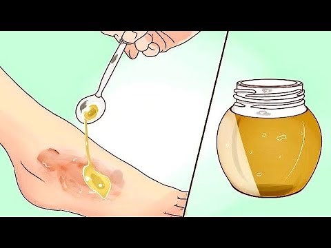 Put Raw Honey On Burns And Wounds, THIS Will Happen