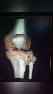 Tibia proximal fracture tibia plateau fracture #hospital #fracturehealing