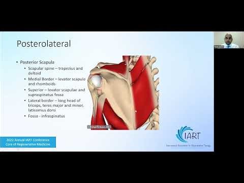 Day 2 Main Track 8 Anatomy and Injection Techniques – Shoulder Ripal Parikh, DO