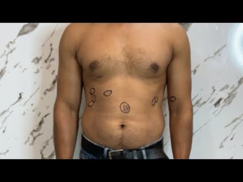 Multiple Lipoma Removal Live Before Procedure #lipoma #lipomatreatment #lipomaremoval #lumps