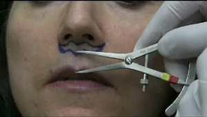 Performing Upper Lip Lift